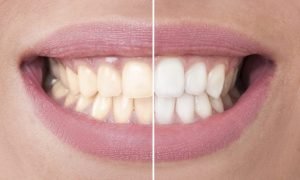 Teeth Whitening Boca Raton