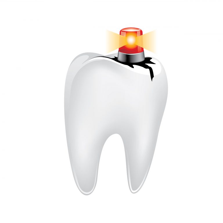 Can Dental Fillings Treat Tooth Decay? - Arc Advanced Dentistry