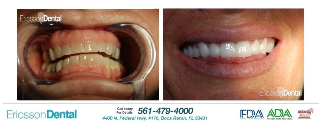 smile makeover boca raton