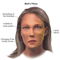 Bell palsy treatment